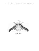 BONE IMPLANTS FOR ORTHOPEDIC PROCEDURES AND CORRESPONDING METHODS diagram and image