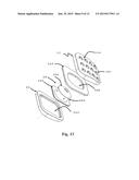 SHOCK ABSORBING, TOTAL DISC REPLACEMENT PROSTHETIC diagram and image