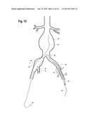 DELIVERY DEVICE WITH AN EXTENSION SHEATH AND METHODS OF USING THE SAME diagram and image