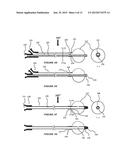 DEVICES AND METHODS FOR THE TREATMENT OF VASCULAR DISEASE diagram and image