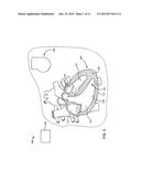 LEADLESS PACEMAKER WITH END-OF-LIFE PROTECTION diagram and image