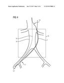 Image Monitoring During an Interventional Procedure, X-Ray Device,     Computer Program and Data Medium diagram and image