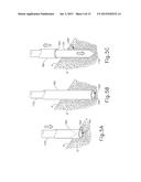 ULTRASONIC BONE CUTTING INSTRUMENT diagram and image