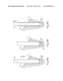 ULTRASONIC BONE CUTTING INSTRUMENT diagram and image