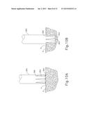 ULTRASONIC BONE CUTTING INSTRUMENT diagram and image