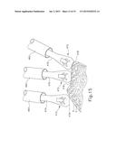 ULTRASONIC BONE CUTTING INSTRUMENT diagram and image