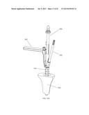 INSTRUMENTS AND METHODS FOR SHAPING A BONE CAVITY diagram and image