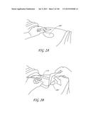 WOUND DRESSING AND METHOD OF TREATMENT diagram and image