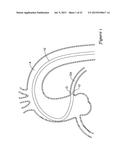 GUIDE EXTENSION CATHETER diagram and image