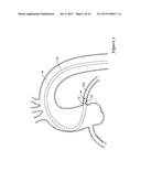 GUIDE EXTENSION CATHETER diagram and image