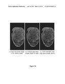 CONVERTING LOW-DOSE TO HIGHER DOSE MAMMOGRAPHIC IMAGES THROUGH     MACHINE-LEARNING PROCESSES diagram and image