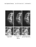 CONVERTING LOW-DOSE TO HIGHER DOSE MAMMOGRAPHIC IMAGES THROUGH     MACHINE-LEARNING PROCESSES diagram and image