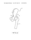 RETRACTOR TOOLS FOR MINIMALLY INVASIVE HIP SURGERY diagram and image