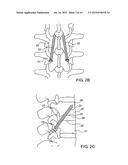 Robot Guided Oblique Spinal Stabilization diagram and image