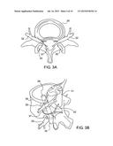 Robot Guided Oblique Spinal Stabilization diagram and image