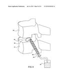 Robot Guided Oblique Spinal Stabilization diagram and image