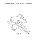 Robot Guided Oblique Spinal Stabilization diagram and image