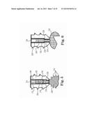 Fixation System for Orthopedic Devices diagram and image