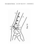 Fixation System for Orthopedic Devices diagram and image