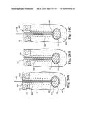 Fixation System for Orthopedic Devices diagram and image