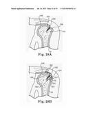 Fixation System for Orthopedic Devices diagram and image