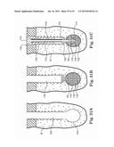 Fixation System for Orthopedic Devices diagram and image