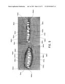 NEGATIVE PRESSURE WOUND CLOSURE DEVICE diagram and image