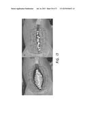 NEGATIVE PRESSURE WOUND CLOSURE DEVICE diagram and image