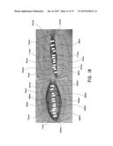 NEGATIVE PRESSURE WOUND CLOSURE DEVICE diagram and image