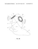 MAGNETIC STIMULATION COILS AND FERROMAGNETIC COMPONENTS FOR REDUCED     SURFACE STIMULATION AND IMPROVED TREATMENT DEPTH diagram and image