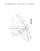 METHOD AND APPARATUS FOR REPAIRING A TENDON OR LIGAMENT diagram and image