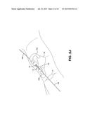 METHOD AND APPARATUS FOR REPAIRING A TENDON OR LIGAMENT diagram and image