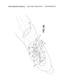 METHOD AND APPARATUS FOR REPAIRING A TENDON OR LIGAMENT diagram and image