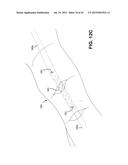 METHOD AND APPARATUS FOR REPAIRING A TENDON OR LIGAMENT diagram and image