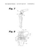 PATIENT MATCHED INSTRUMENT diagram and image