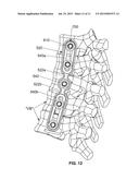 SPINAL STABILIZATION SYSTEM diagram and image