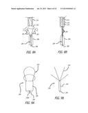 DEVICE AND METHOD FOR TREATMENT OF HEART VALVE REGURGITATION diagram and image