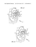 DEVICE AND METHOD FOR TREATMENT OF HEART VALVE REGURGITATION diagram and image