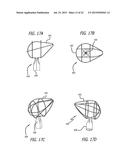 DEVICE AND METHOD FOR TREATMENT OF HEART VALVE REGURGITATION diagram and image