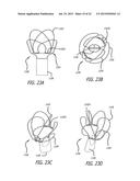 DEVICE AND METHOD FOR TREATMENT OF HEART VALVE REGURGITATION diagram and image