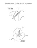 DEVICE AND METHOD FOR TREATMENT OF HEART VALVE REGURGITATION diagram and image