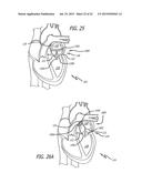 DEVICE AND METHOD FOR TREATMENT OF HEART VALVE REGURGITATION diagram and image