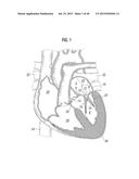 PROSTHETIC VALVE FOR REPLACING MITRAL VALVE diagram and image