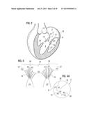 PROSTHETIC VALVE FOR REPLACING MITRAL VALVE diagram and image