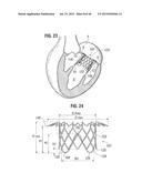 PROSTHETIC VALVE FOR REPLACING MITRAL VALVE diagram and image