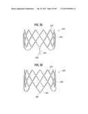 PROSTHETIC VALVE FOR REPLACING MITRAL VALVE diagram and image