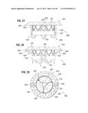 PROSTHETIC VALVE FOR REPLACING MITRAL VALVE diagram and image