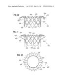 PROSTHETIC VALVE FOR REPLACING MITRAL VALVE diagram and image