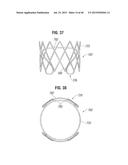 PROSTHETIC VALVE FOR REPLACING MITRAL VALVE diagram and image