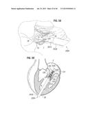 PROSTHETIC VALVE FOR REPLACING MITRAL VALVE diagram and image